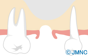 1.歯槽骨の吸収と上顎洞の拡大