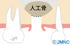 3.上顎洞底の押し上げと骨補填材の填入