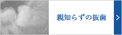 他医院では難しく、大学病院を紹介されるケースも、 ひろた歯科では抜歯が可能です。
