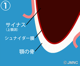 1.歯槽骨の吸収と上顎洞の拡大