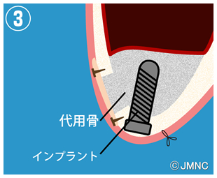 3.移植骨や骨補填材の填入