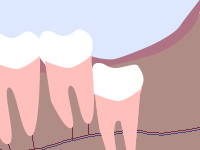 真っすぐ生えていれば、奥歯と同じように抜歯が可能